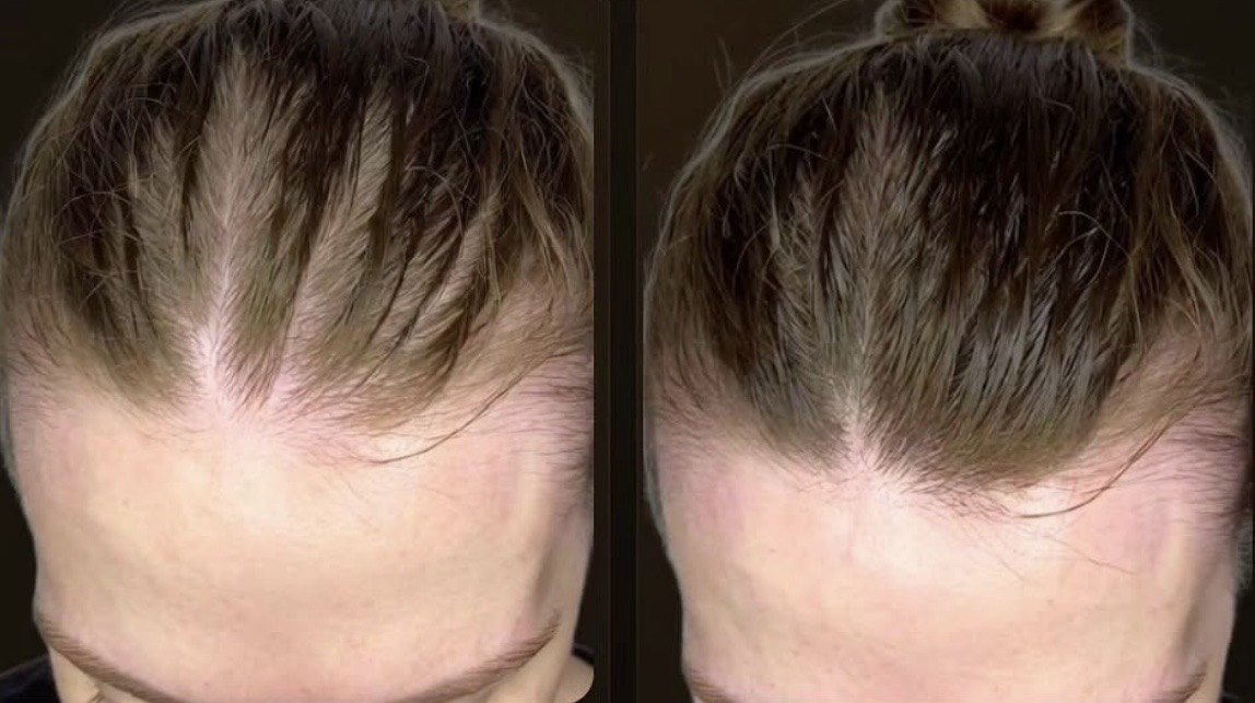 Couro cabeludo antes e depois