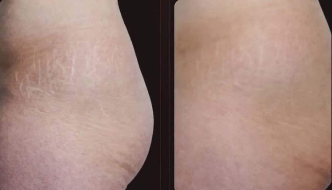 Estrias antes e depois