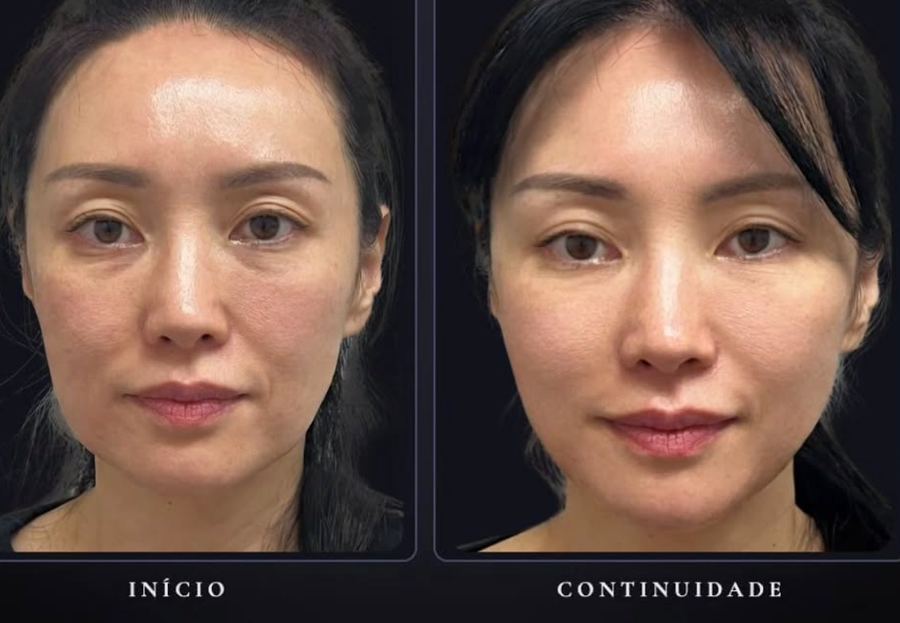 Fiobloc antes e depois
