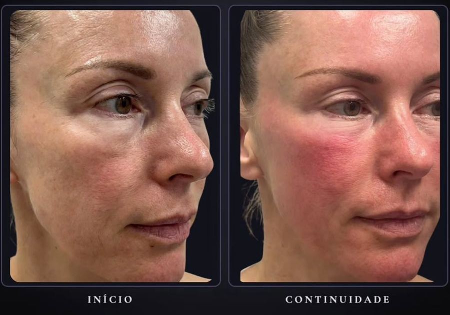 Fios antes e depois