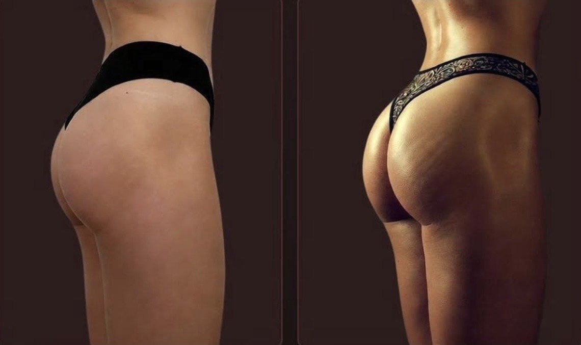 Glúteo antes e depois do SKINCODE Contour
