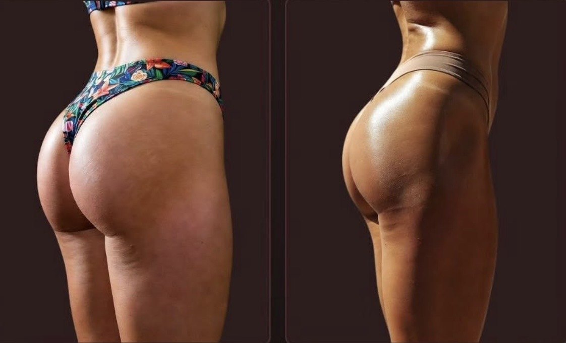 Glúteo antes e depois