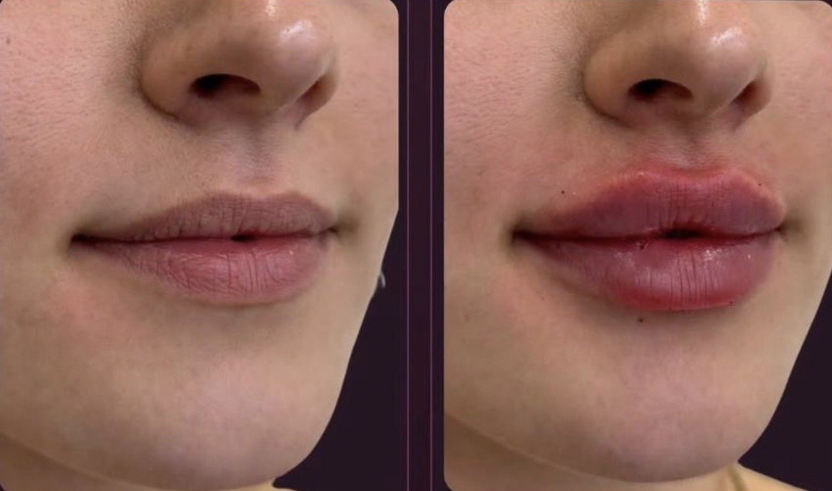 Lábios antes e depois