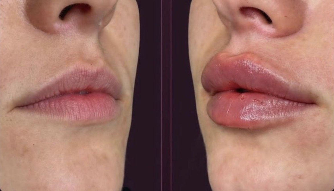Lábios antes e depois, perfil