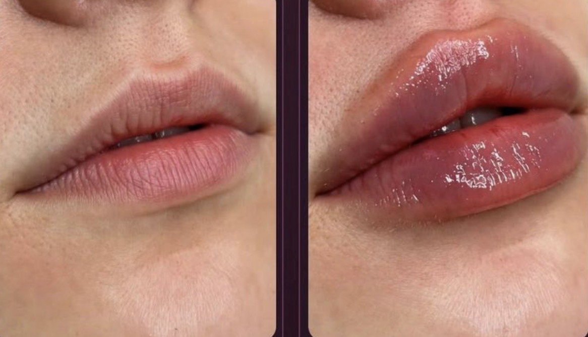 Lábios antes e depois, frontal
