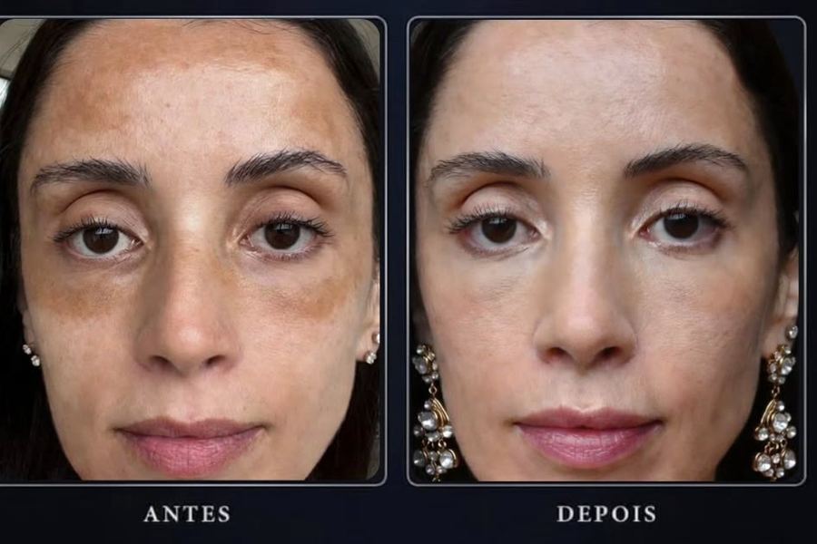 Melasma antes e depois