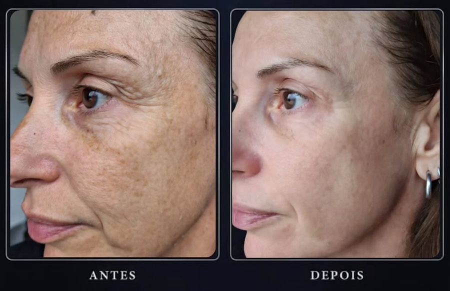 Manchas e textura antes e depois