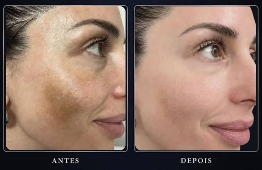Mancha na maçã do rosto antes e depois