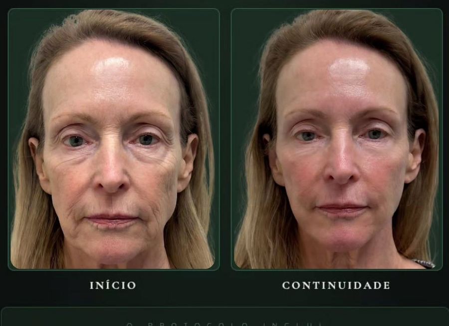 R.E.G.E.N.E.R.A.: início, 90 e 120 dias