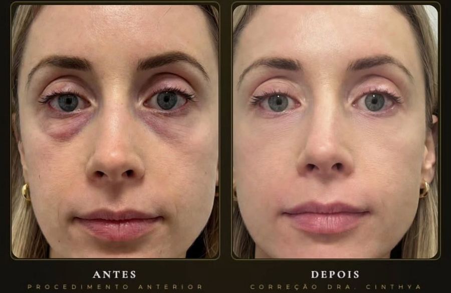 Olheiras, antes e após correção