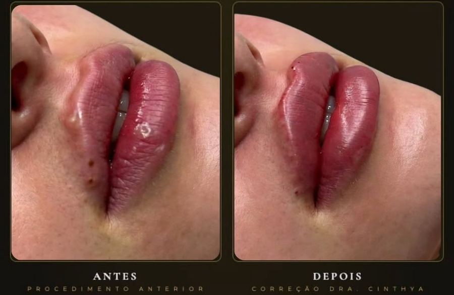 Lábios com excesso, antes e após correção