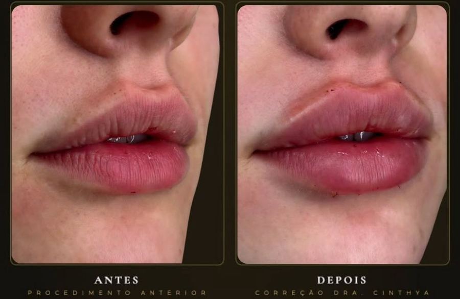 Lábios, antes e após correção
