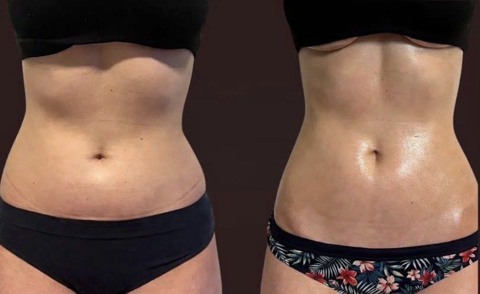 Abdômen antes e depois