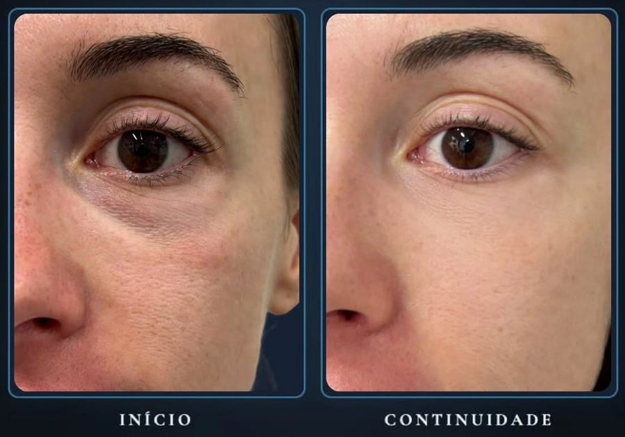 Sulco lacrimal antes e depois