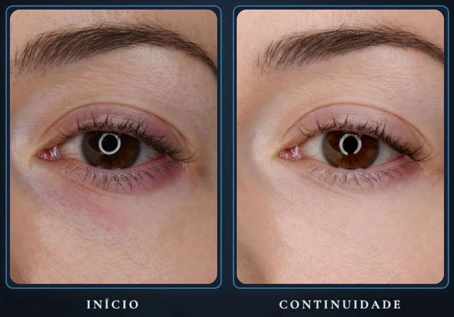 Olheira antes e depois